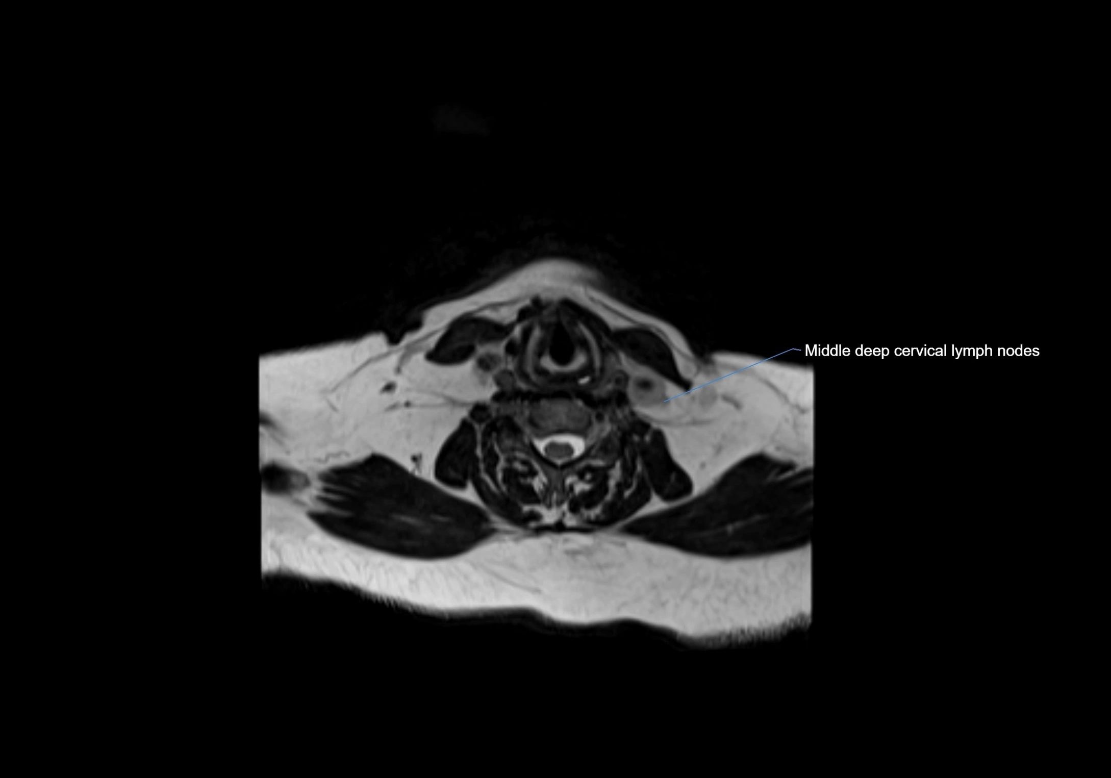Neck axial  lymph node cross sectional MRI anatomy 3T MRI  image-img-00001-00068.webp